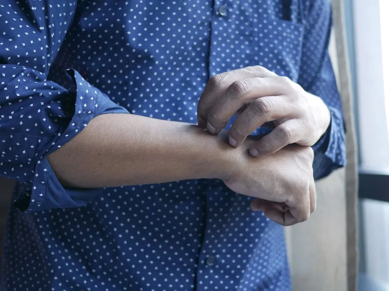 Pharmacist assessing infected insect bite